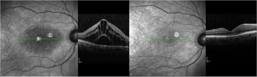 Figure 4 Patient with chronic CME. CME before nepafenac administration and after 4 months therapy. Visual acuity changed from 0.50 logMAR to 0.30 logMAR, and central macular thickness decreased from 499 μm to 255 μm. Green line represents the same area of the fovea prior to and after therapy in infrared picture, which corresponds to CME improvement.