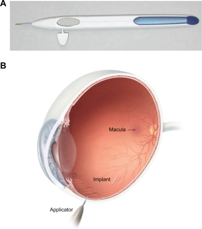 Figure 1 Dexamethasone Posterior Segment Drug Delivery System® Applicator and approximate vitreous location of dexamethasone implant after insertion. The implant is approximately 6 mm long and is inserted into the vitreous cavity through the 22-gauge needle of the applicator.