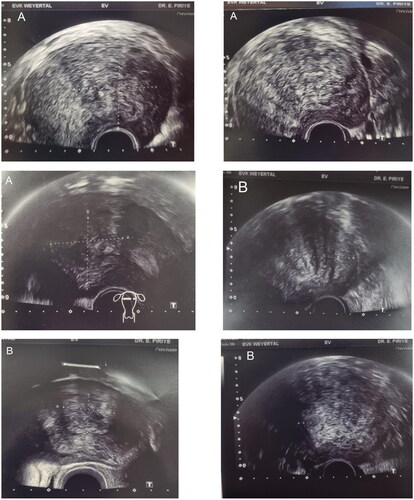 Figure 2. Preoperative and postoperative ultrasound imaging. (A) Preoperative ultrasound imaging; (B) postoperative ultrasound imaging; DR. E. PIRIYEV: name of the first author; Weyertal: name of the hospital.