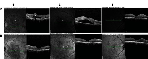 Figure 3 Effect of the curcumin-lecithin formulation (Norflo®) on OCT retinal thickness after 12 months. The images represent three different cases (from left to right, 1–3), evaluated at different times (at first visit, A, and at follow up, B). The green line identifies the area analyzed in cross sectional mode and reported in the image on the right.