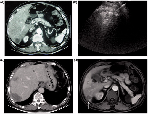 Figure 3. A 77-year old man with liver metastasis of colon cancer received percutaneous conventional tumour RFA. Local tumour progression occurred one year after tumour ablation. (A) Arterial phase in enhanced CT before RFA: the hypo-enhanced metastasis tumour was located the inferior margin of Segment 6. (B) The tumour was directly coagulated by simultaneous RF application with three electrodes. (C) Enhanced CT one month after RFA showed no tumour residue was found in the coagulated area. (D) Enhanced MRI (T1WI in arterial phase) one year after treatment showed tumour local progression at the inferior of coagulated area (arrow).