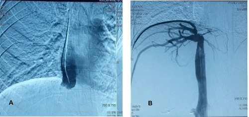 Figure 2 Trans-jugular (A) and trans-femoral (B) catheter venography of the IVC showing total occlusion of the suprahepatic portion of the IVC, with tight stenosis of its junction with the hepatic veins and multiple dilated collaterals.