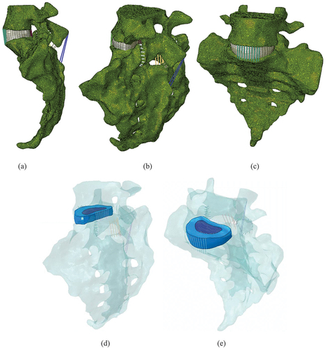 Figure 1. Different views of L5-S1 in-silico model, (a) Sagittal view, (b) Posteriolateral view, (c) Anteriolateral view, Transparent vertebrae, and opaque IVD, and ligaments in-silico model of L5-S1 segment (d) Posteriolateral view and (e)Anteriolateral view.