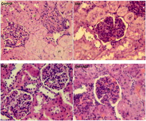 Figure 5. Histological staining with H&E in the kidney tissues of control rats, diabetic rats (DM), diabetic rats that treated with garlic extract (DM + AGE) and normal rats that received garlic extract (AGE). GL: glomerulus, PT: proximal tube, DT: distal tube. *Interstitial inflammation and → Bowman capsule space.