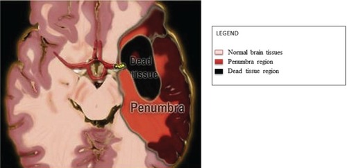Figure 3 Core and penumbra after stroke.