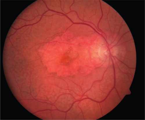Figure 2 Color fundus photograph of a right eye with central geographic atrophy. Note the central RPE pigment attenuation.