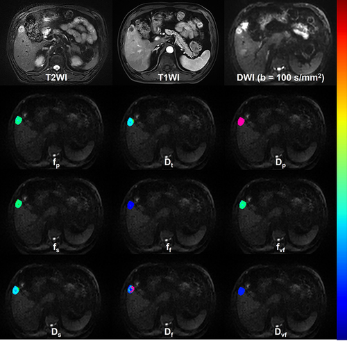 Figure 2 Representative MRI images including the T2WI, T1WI, DWI of b = 100 s/mm2 and bi-IVIM-derived parametric maps (fp, Dt and Dp) as well as tri-IVIM-derived parametric maps (fs, ff, fvf, Ds, Df and Dvf) of a patient with MVI-negative HCC.