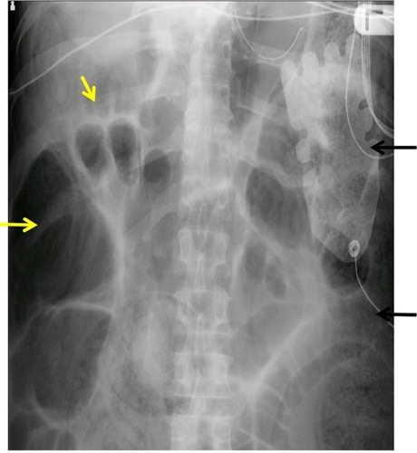 Figure 2 Abdominal X-ray with dilated small bowel (yellow arrows) and fecal impaction (black arrows).