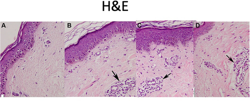Figure 1 Skin biopsy from striae stained with Haematoxylin and Eosin (scale 50 μm). (A) Before treatment, (B) after 3 sessions of combined treatment, (C) after 3 sessions of fractional laser/RF, (D) after 3 sessions of PRP. Note the increase in number of fibroblasts and vascularity in all biopsies after treatment to variable degrees. Black arrows refer to fibroblasts and vascularity increasing after treatment.