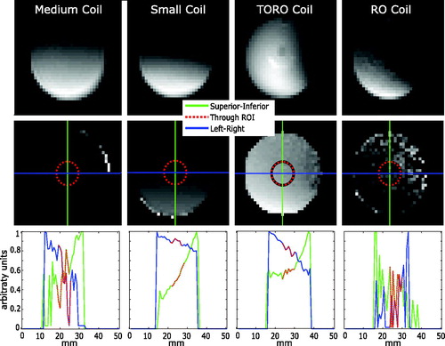 Figure 8. B1 maps obtained using the medium (first column), small (second column), TORO (third column) and RO (fourth column) coils. The first row shows the magnitude images for a flip angle of 2α (60 °C). The second row shows the B1 maps with superior-inferior (green) and left-right (blue) profile lines through the center of a 3-mm-radius ROI (red). The bottom row shows the intensity profiles in the superior-inferior (green) and left-right (blue) directions with the target region used for hyperthermia highlighted in red.