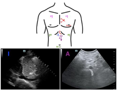 Figure 3 Diagram of the views obtained for completion of the RUSH exam using the HIMAP acronym. H: heart (focused cardiac ultrasound), I: IVC, M: Morrison’s pouch (RUQ followed by completion of an E-FAST exam), A: aorta, P: pneumothorax (already covered via E-FAST exam). Corresponding sonographic images of the IVC and aorta are included.