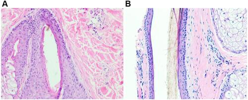 Figure 18 Hematoxylin and eosin stain (×10 magnification) of the scalp of patient 13 (African descent) showing perifollicular fibroblast arrangement in the occipital area, which is thin (A), compared with a thicker appearance in the parietal region (B).