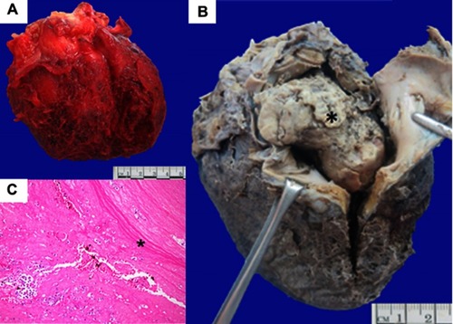 Figure 1 Heart with intracardiac thrombus. (A) Fresh specimen, anterior aspect. External appearance of the heart with fibrinous pericarditis. (B) Ten percent neutral formalin-fixed specimen, right lateral aspect. Opening of the right atrial chamber showed an intracardiac thrombus (asterisk) that extended into the right ventricular chamber. (C) Histopathological examination of the intracardiac thrombus showed a recanalized and organized (asterisk) thrombus. Hematoxylin and eosin; original magnification, 20×.