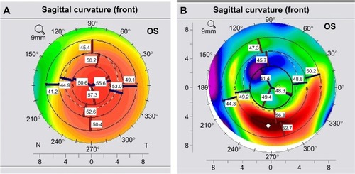 Figure 6 Figure shows the flattening effect of the MyoRing, (A) left showing topography of a cornea with evident keratoconus and (B) same eye after MyoRing.