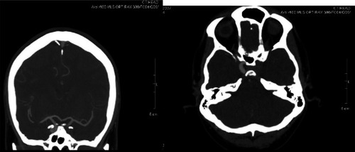 Figure 1 CT angiogram of blocked ICA.