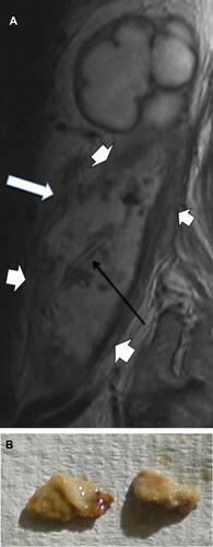 Figure 8 (A) MRI showing grossly distended calyces in the upper pole and a complex abscess cavity with a dramatically thickened, infiltrative wall (short white arrows) and innumerable foci of contained debris. The abscess arose secondary to erosion of irregular calculi through the renal pelvis, creating a sinus (long white arrow). A drainage catheter is evident within the abscess cavity (black arrow), placed via an accessed open sinus in the groin. (B) Two of the calculous fragments extracted from the abscess cavity via the groin.