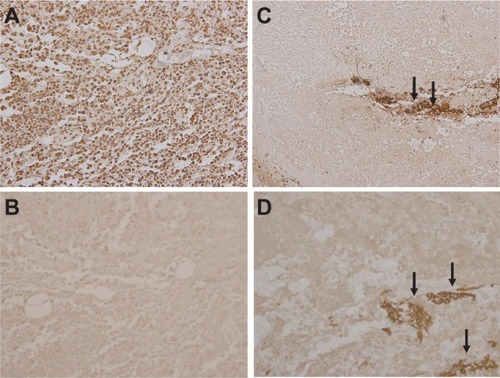 Figure 5 TUNEL staining of tumors in each group. (A) Positive control for TUNEL staining. Brown staining cells indicate TUNEL-positive cells, (B) group 1, and (C) group 2. Irradiation of alternating magnetic field alone or injection of ferucarbotran alone did not induce apoptosis in lung cancer cells. (D) In group 3, inductive hyperthermia did not increase apoptotic cells around ferucarbotran (arrows) compared with groups 1 or 2 (TUNEL staining ×200 field).