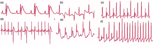 Figure 8. ECG recorded from extremities in standard lead II. a: Normal ECG; b: Ventricular bigeminy occurred in surgery group; c: Ventricular trigenimy occurred in surgery group; d: Frequent premature ventricular contractions occurred in surgery group; e: Myocardial ischemia occurred in surgery group; f: Paroxysmal ventricular tachycardia occurred in group.