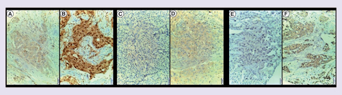 Figure 3.  Protein expression of SOHLH2, DNAJC12, and LIM1 studied by immnohistochemistry on tissue microarrays containing TNBC samples.SOHLH2 protein showed nuclear and cytoplasmic staining: (A) tumor cells with cytoplasmic weak staining. (B) Nuclear and cytoplasmic positive staining of tumor cells with a discreet stromal staining. DNAJC12 protein showed cytoplasmic staining. (C) Negative staining. (D) Cytoplasmic positive staining. LIM1 protein showed cytoplasmic staining. (E) Negative staining. (F) Positive staining.Magnification: 20x.