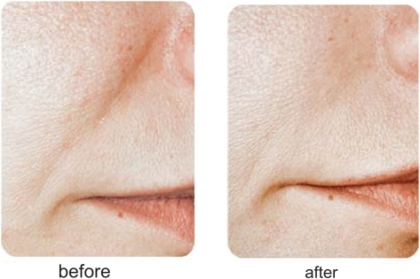 Figure 7 A clinical example of the use of Puragen™ for nasolabial folds.