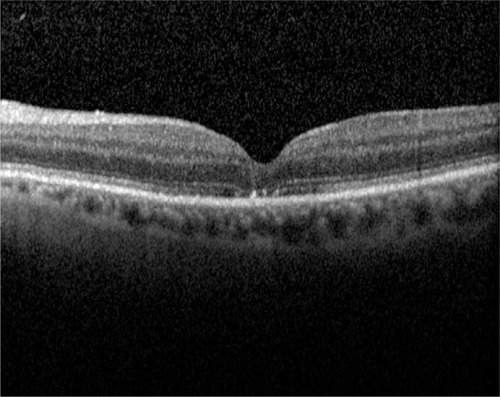 Figure 2 Postoperative optical coherence tomography showing successful closure of the macular hole with a normal foveal depression.