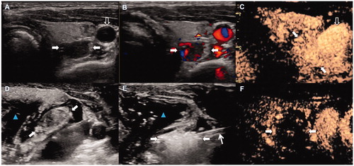 Figure 1. Percutaneous MWA of SHPT nodule in a 56-year-old man. Routine US showed a hypoechoic SHPT nodule (white arrows) behind left lobe of thyroid and on right side of carotid artery (black arrow). B. Color Doppler US showed abundant blood flow signals in the nodule (arrows). C. Uniform hyperenhanced SHPT nodule (white arrows) was beside carotid artery (black arrow) in arterial phase on CEUS. D. Injection of hydrodissection (blue arrowhead) around SHPT nodule (white arrows) before MWA. E. MWA procedure of SHPT nodule: hyperechoic area emerging inside nodule (arrows)-which surrounded by hydrodissection (blue arrowhead), around antenna (white arrowhead). F. After MWA, nonenhancement area covered SHPT nodule (arrows) in CEUS image. CEUS: contrast-enhanced US; MWA: microwave ablation; SSHPT: secondary hyperparathyroidism; US: ultrasound.