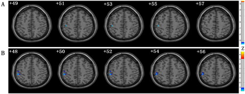 Figure 1. Clusters with significantly altered mALFF values among groups. The blue-yellow areas denote lower mALFF values in the MHD-CI group than in the (A) MHD-NCI group or (B) HC group. mALFF: mean low-frequency amplitude; MHD-CI: maintenance hemodialysis patients with cognitive impairment; MHD-NCI: maintenance hemodialysis patients without cognitive impairment; HC: healthy controls.