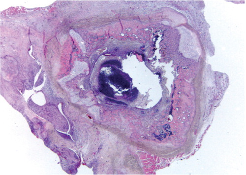 Figure 4. Severe inflammation with intramedullary abscess in the femur (score = 8).