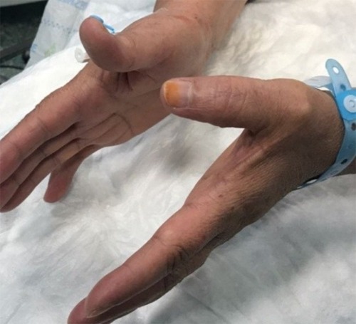 Figure 1 The patient cannot extend left thumb IPJ.