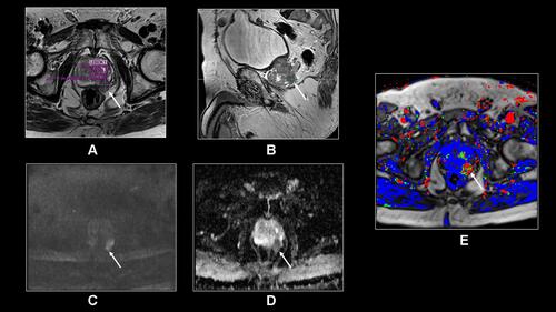 Figure 2 Transverse T2-weighted TSE (A), sagittal T2-weighted TSE (B), transverse DWI (C), ADC map (D) and T1-weighted DCE primary perfusion map (E) demonstrate a PIRADS 5 lesion with extracapsular extension and neurovascular bundle involvement on the left side posterolaterally (arrows, a-e). The lesion shows dark T2 signal (A and B) with associated diffusion restriction (C and D) and increased perfusion (E). The lesion is a Gleason 4+4 tumor.