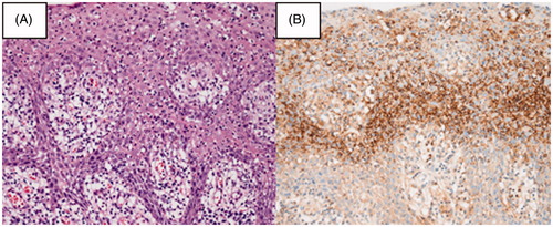 Figure 4. Pathological examination of the right tonsil. (A) Hematoxylin and eosin (HE) staining showing infiltration of leukocytes. (B) Staining showing immunopositivity for Treponema pallidum.