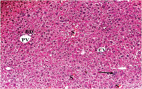 Figure 7. A photomicrograph of a section of liver of HCC treated with IQ (10 mg/kg bw) showing disorganized hepatic cords. Central vein (CV), Portal vein (PV) with bile ductule (BD) and congested sinusoids (S) are seen. Hepatocytes with vacuolated cytoplasm and mild inflammatory infiltrate (arrow) are also seen (H&E x100).