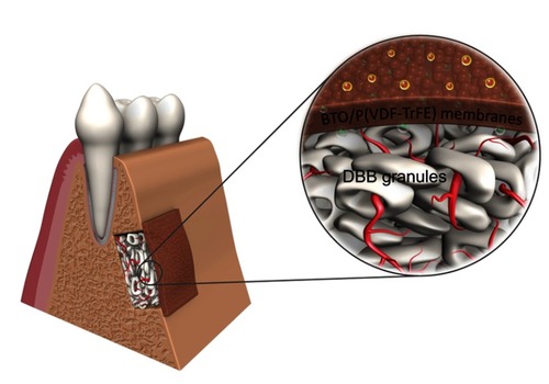 Figure 8 Illustration of the synergistic effects of combining piezoelectric BTO/P(VDF-TrFE) nanocomposite membranes with xenogenic DBB grafts on the repair of critical-sized bone defects. Electric dipoles of BTO NPs are reoriented in the direction of the poling electric field after corona poling treatment, and consequently polarized charges are generated on the surface of BTO/P(VDF-TrFE) nanocomposite membranes. When the membranes are implanted as a barrier membrane covering the bone defect filled with DBB grafts, the electric microenvironment is sustainably maintained, resulting in enhanced neovascularization and rapid bone regeneration, which consequently led to complete mature bone-structure formation integrated with the implanted DBB grafts.Abbreviations: DBB, deproteinized bovine bone; BTO, BaTiO3; P(VDF-TrFE), poly(vinylidene fluoridetrifluoroethylene).