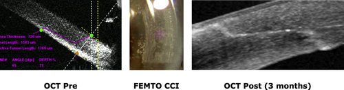 Figure 2 Femtosecond laser-created corneal wound and the evolution of incision profile over time.