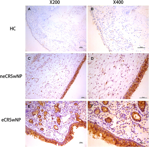 Figure 6 The ALCAM protein expression in the tissue based on IHC. Representative images of ALCAM staining from HCs (A and B), eCRSwNP patients (C and D) and neCRSwNP patients (E and F).