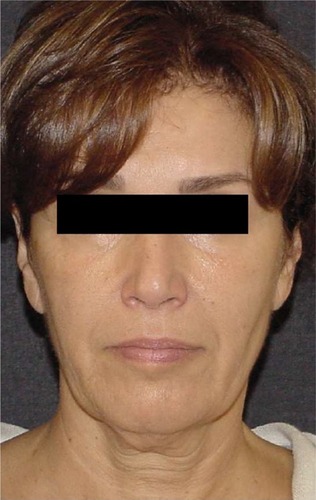 Figure 8 Image of a 48-year-old woman who underwent facelift surgery.