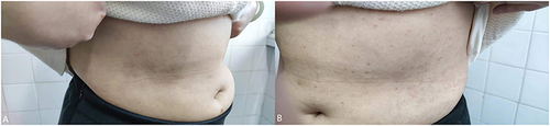 Figure 3 (A and B) 14 days after treatment with abrocitinib.