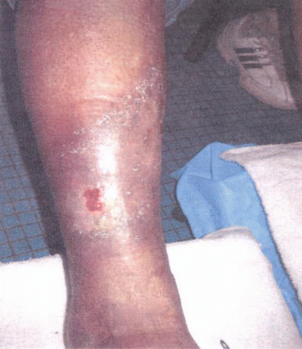 Figure 3 Healing leg ulcer after androgen therapy.
