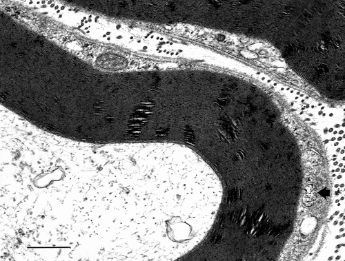 Figure 8. Enlarged sector of a fa/fa sciatic nerve fiber showing the Cajal band contains either marbled (arrow) or emptied-like vacuoles facing the abaxonal membrane (arrow) seemingly in contact with the abaxonal myelin, displaying ovoid-shaped alterations rupturing locally the periodicity of the packed myelin annulus. Note along its perimeter and through that annulus the aligned dense component that contrasts as electron dense striped lines into the initial myelin layers that reach deep in it. The basal lamina surrounds the entire SC with its noted extracellular matrix. Scale equals 500 nm.
