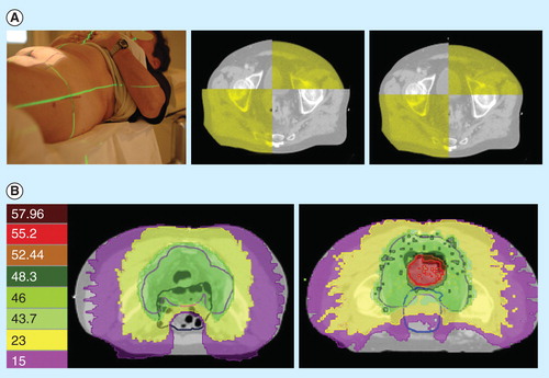 Figure 1. Intensity-modulated and image-guided radiotherapy (IMRT-IGRT) for rectal cancer. (A) Positioning by image-guided radiotherapy (right) improves the positioning accuracy compared with laser skin marks (left). (B) Intensity-modulated radiotherapy allows dose sculpting around the target volume while sparing the small bowel (left), and delivering a simultaneous integrated boost (right).