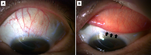 Figure 1 Slit lamp examination at initial presentation revealed (A) a localized hyperemia and (B) redundant folds (pointed with black arrows) of the superior bulbar conjunctiva.