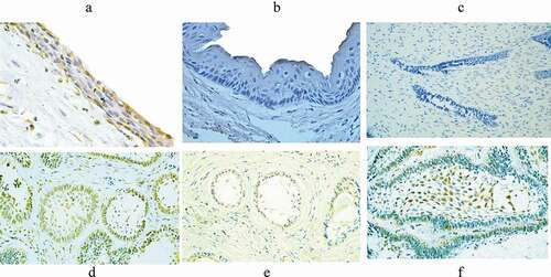 Figure 1. Immunohistochemical expression of HCMV-gB in the studied odontogenic lesions. The positively stained cells in dentigerous cyst were distributed throughout the epithelial wall (A), absence of staining in odontogenic keratocyst (B), negative staining in ameloblastoma (AB) (C), heavy expression of HCMV-gB in both the peripheral columnar cells and the stellate reticulum‒like cells of AB (D), more positive expression in the peripheral columnar cells of AB (E), and (F) more positive expression in the stellate reticulum‒like cells of AB