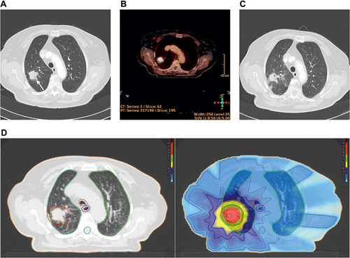 Figure 6 PET for tumour detection. (A): 89-year-old female patient with a tumour-related finding on a CT-scan (size 23 mm, white arrow), no histological examination was performed due to poor constitution. (B): PET/CT for treatment planning with a SUVmax = 17.1, suspicious of a tumour. SBRT was done. (C): Stable disease at 3 months with radiological radiation pneumonitis. On follow-up (at 12 months), the tumour failed to decline (data not shown). (D left): Tumour within the planning target volume (red contour) and organs at risk: Total lung (green), spinal cord (turquoise), oesophagus (violet) and trachea (orange). (D right): Treatment plan (IMRT-technology, 7 Gy in 5 fractions, total dose 35.0 Gy): Isodose lines (% of total dose) and the dose distribution, high-dose region surrounding the tumour (red, green), step down gradient (yellow, dark blue), and a large low-dose region highlighted in blue.