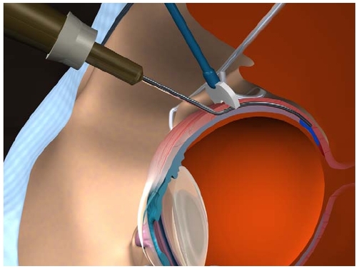 Figure 2 The unique design of the blunt tinted posterior juxtascleral depot cannula ensures that anecortave acetate is delivered directly behind the macula while leaving the globe intact.