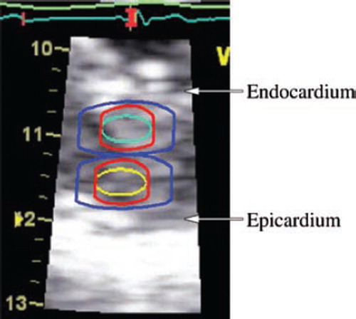 Figure 2. Sampling for two-layer-measurement, demonstrated on an image frozen in end-systole. Cyan and yellow are original regions of interest in the subendocardial and subepicardial halves, 3*6 mm. The red extension indicates the additional sampling of ½ strain length in the axial direction on both sides of the region of interest. In this recording with strain length = 2 mm, 1 mm is added on either side. The blue extension depicts minimum averaging (RA1/LAI in this study) and is an indication of the limitation in image resolution. Resolution is, in the radial direction ½ pulse length ≈ 0.5 mm, and in the lateral direction up to one beam width ≈ 3 mm. The resulting total sampling dimensions are approximately 6*10 mm (blue extension).