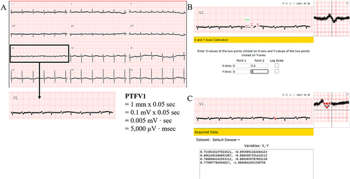 Figure 2 P-wave terminal force in lead V1 (PTFV1) measurement by WebPlotDigitizer (A) 12-lead echocardiography with PTFV1, (B) X and Y axes calibration, and (C) acquired data and PTFV1 calculation. PTFV1 = 5000 µV msec.