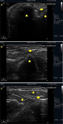 Figure 2 Ulnar nerve cross-section area on ultrasonography.