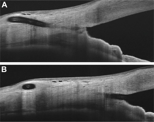 Figure 8 (A and B) AS-OCT analysis of XEN45 bleb at 6 months.