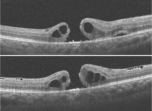 Figure 8 FTMH noticed one week after vitrectomy. There is prominent ERM and intraretinal cystoid edema. Also, there is a “bump” in the outer retinal (of uncertain significance). Tangential traction is present in this case.
