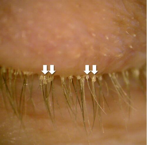 Figure 2 Demodex-associated blepharitis with classic cylindrical dandruff (white arrows).
